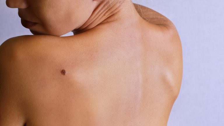 Causes of skin cancers