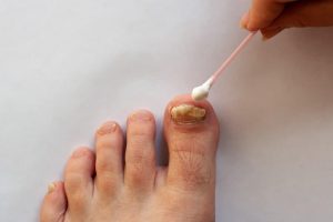 How to Prepare Yourself for Nail Fungus Infection Treatment