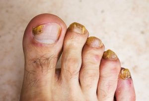 Nail Fungal Infection Treatment- The Best Treatment Options Available