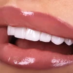 Porcelain Vs. Composite: Which Dental Veneer Is Right For You?